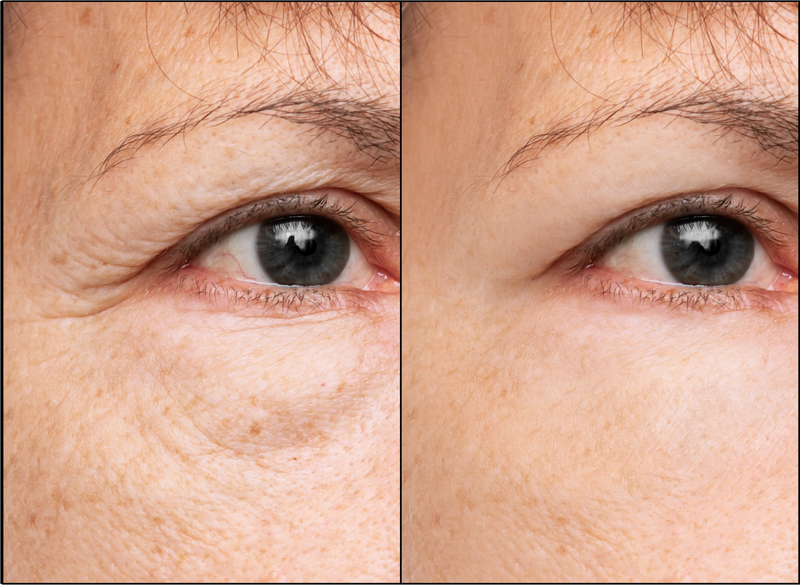 Experience smoother and more youthful-looking skin after finishing the anti-aging treatment at B+ Clinic Malaysia.