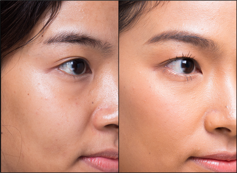 Youthful and refreshed look after completing non-surgical treatment at B+ Clinic Malaysia