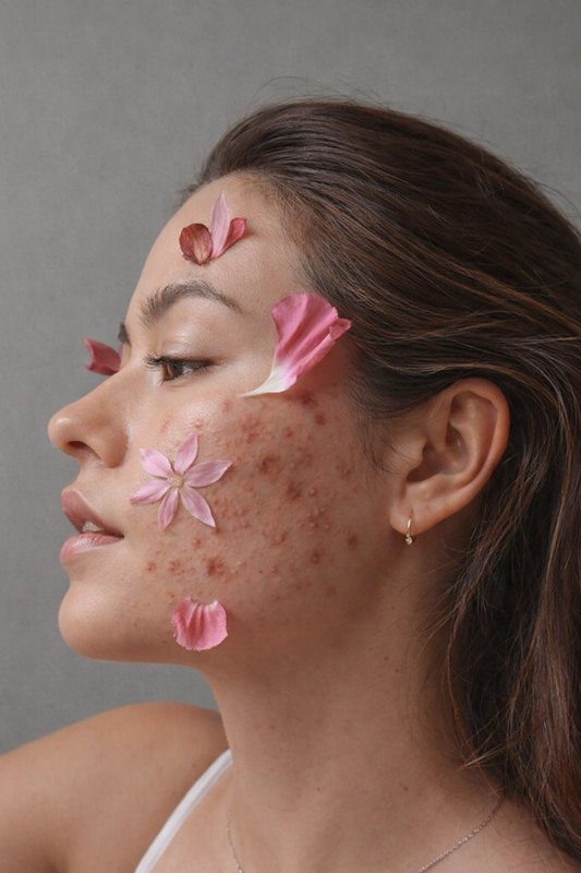 Can Acne Scars Be Fully Removed?