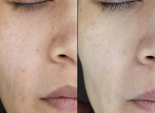 skin becomes firmer and more elastic after anti-aging injection treatment at B+ Clinic Malaysia