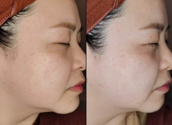 pore size improvement after anti-aging injection at B+ Clinic Malaysia