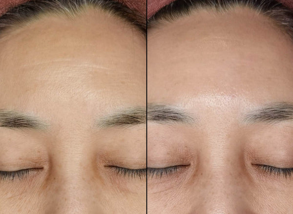 reduction of wrinkles and fine lines after anti-aging treatment at B+ Clinic Malaysia